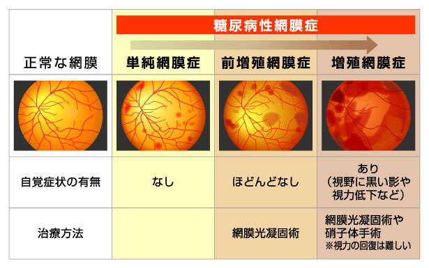 糖尿病と血管障害－第5回 糖尿病と眼病変／教えて！「健康コラム」／糖尿病特集サイト／メディマグ. 糖尿病